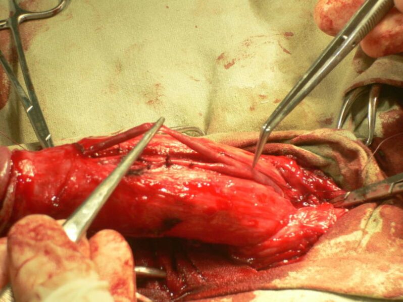 λιποπλήρωση του πέους για μεγέθυνση