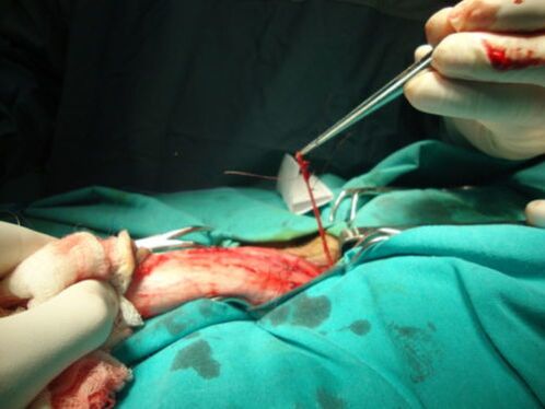 χειρουργική επέμβαση μεγέθυνσης πέους