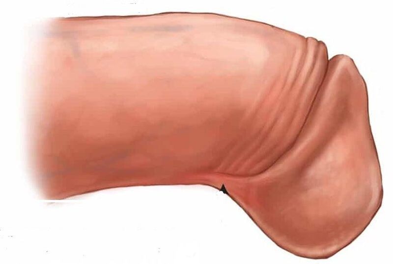 πώς να μεγεθύνετε τη βάλανο του πέους